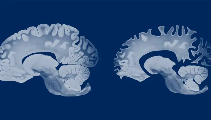 Ngủ chập chờn không sâu giấc kéo dài sẽ gây suy giảm trí nhớ và mắc các bệnh lý khác 