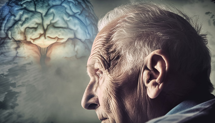 Bệnh Alzheimer gây suy giảm trí nhớ