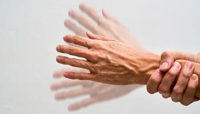 Parkinson là bệnh rối loạn thoái hóa hệ thần kinh