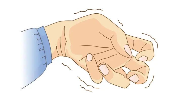 Bệnh Parkinson ở người trẻ là bệnh rối loạn thoái hóa thần kinh mạn tính