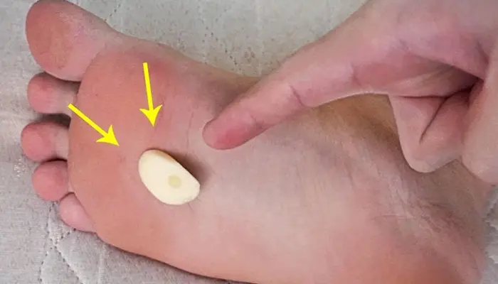 Đắp tỏi vào lòng bàn chân cũng là cách chữa mất ngủ hiệu quả 
