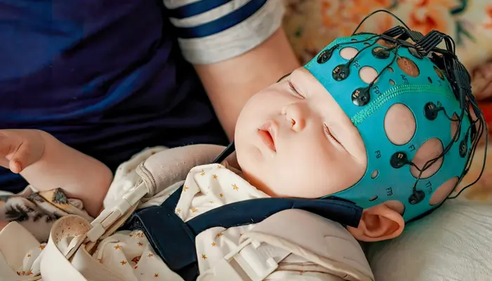 Chẩn đoán hội chứng West qua phương pháp đo EEG 