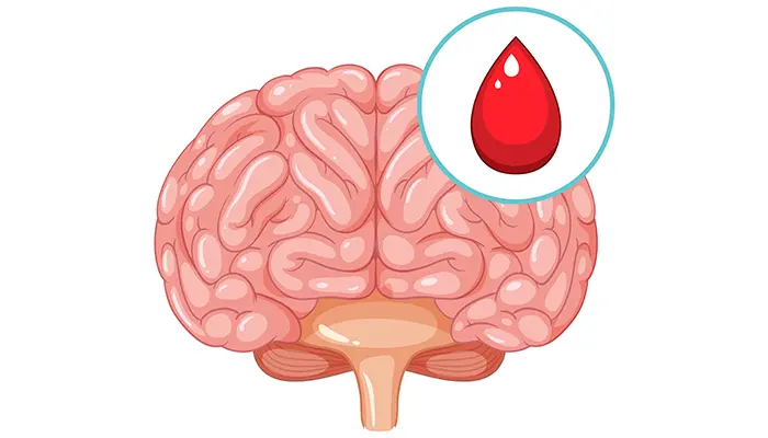Co giật thùy thái dương là dạng động kinh cục bộ 