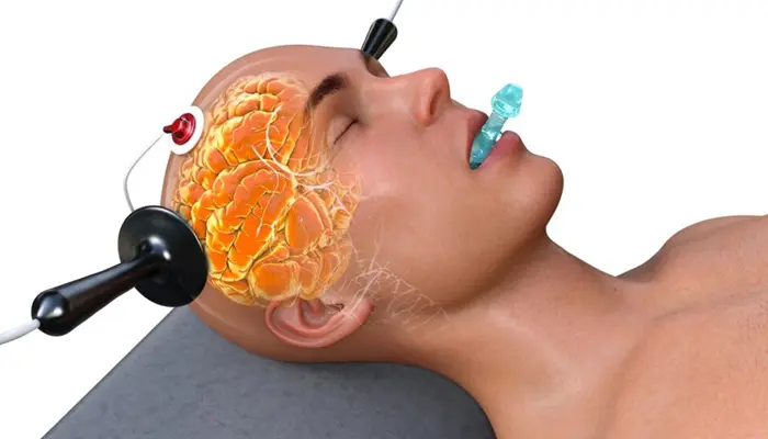 Liệu pháp sốc điện trong điều trị tâm thần phân liệt