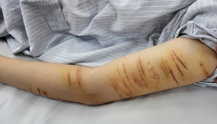 Rạch tay trầm cảm là hành vi tự làm tổn thương cơ thể 