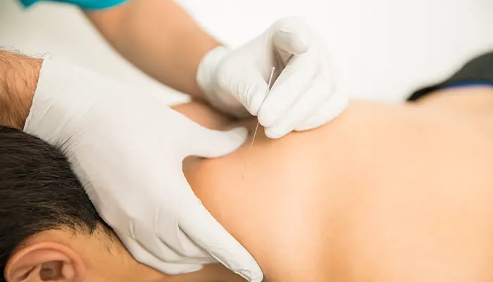 Huyệt Phong trì là một trong số các huyệt vị châm cứu giúp hỗ trợ giảm Parkinson