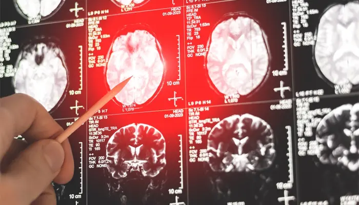 Ngủ nhiều nhưng vẫn buồn ngủ có thể dẫn đến thiếu máu não