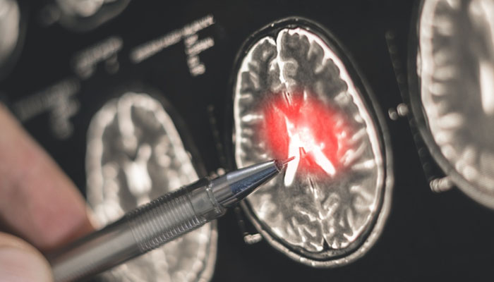 Nguyên nhân bệnh Alzheimer giai đoạn đầu là do hoạt động não bộ