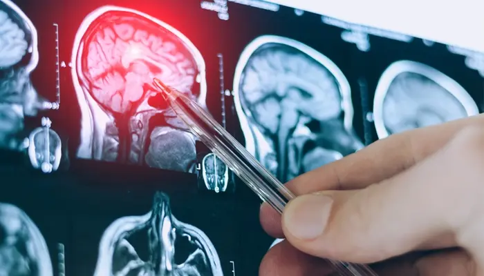 Chấn thương sọ não cũng là nguyên nhân gây ra bệnh Parkinson