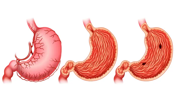 Cơn đau dạ dày làm bạn khó chìm vào giấc ngủ