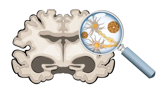 Nguyên nhân gây ra bệnh Alzheimer xuất phát từ não bộ
