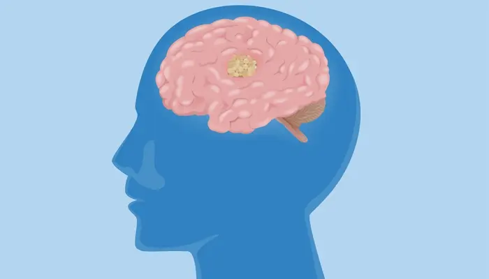 Nguyên nhân gây rối loạn lưỡng cực xuất phát từ sự bất thường của não bộ