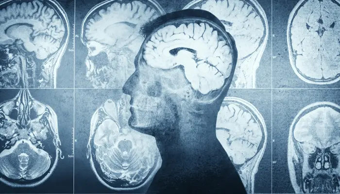 Chưa xác định được nguyên nhân chính xác gây tâm thần phân liệt thể thanh xuân