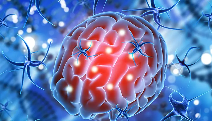 Bất thường cấu trúc não là nguyên nhân bệnh tâm thần phân liệt