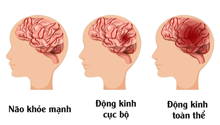 Phân loại các cơn động kinh
