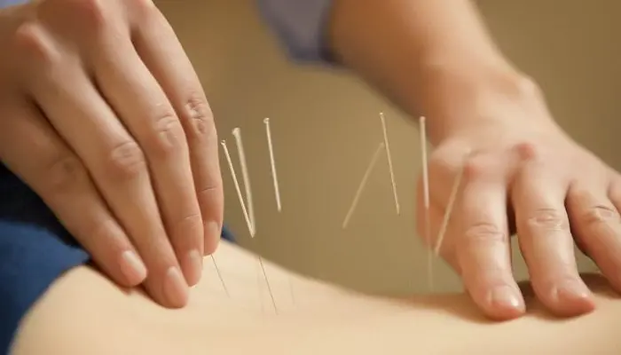 Châm cứu chữa mất ngủ là phương pháp y học cổ truyền tác động vào các huyệt đạo trên cơ thể