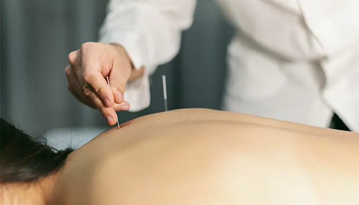 Châm cứu cũng là phương pháp đông y chữa rối loạn lo âu hiệu quả