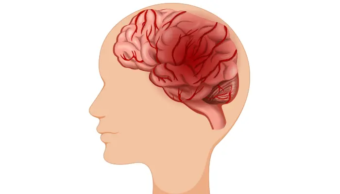 Thiểu năng tuần hoàn não là tình trạng lượng máu cung cấp cho não bị suy giảm