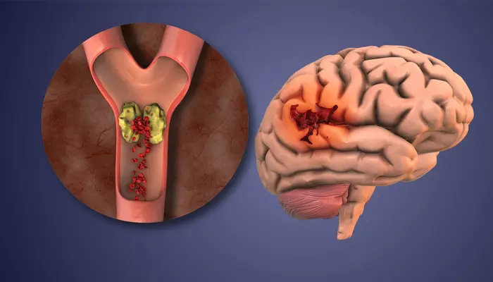 Trầm cảm nội sinh là tình trạng rối loạn bắt nguồn từ sự mất cân bằng trong thần kinh não 