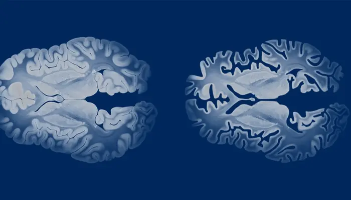 Từng bị chấn thương sọ não cũng là yếu tố làm tăng nguy cơ mắc bệnh Alzheimer