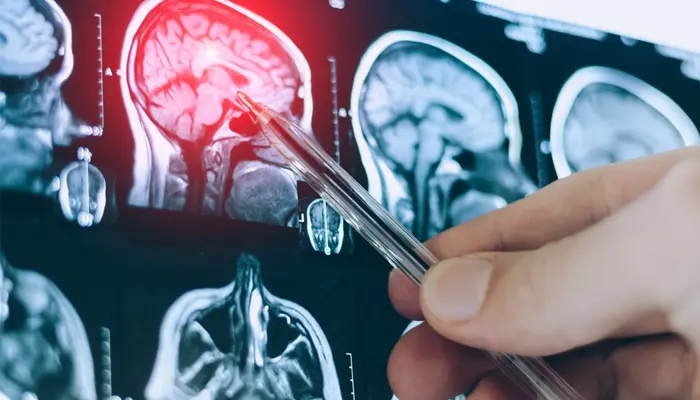 Chấn thương đầu cũng là yếu tố nguy cơ mắc bệnh Alzheimer