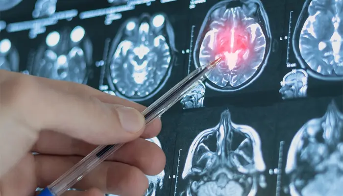 Chấn thương sọ não cũng là yếu tố nguy cơ làm tăng khả năng mắc bệnh Parkinson