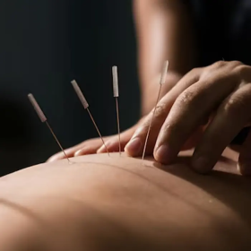 Châm cứu chữa mất ngủ có thật sự giúp bạn ngủ ngon hơn?