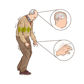 Hội chứng Parkinson thứ phát: Triệu chứng, tiên lượng, điều trị