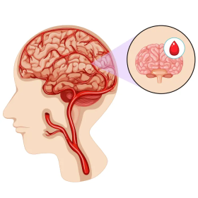 Mất ngủ do thiểu năng tuần hoàn não và điều trị cải thiện giấc ngủ